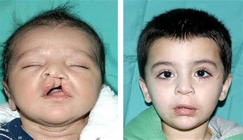 Cleft Lip And Cleft Palate Causes Treatment And Speec - vrogue.co