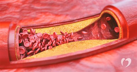 Atherosclerosis: hardening of the arteries | Oklahoma Heart Hospital