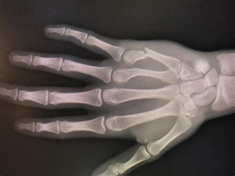 Hand: Metacarpal Fractures – Decatur Orthopedica Center (IL)