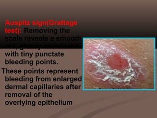 Psoriasis | PPT