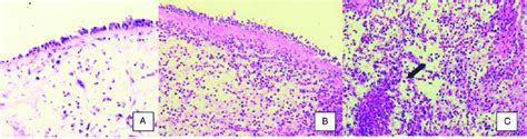 Representative histologic images of CRSwNP specimens with low (A) and... | Download Scientific ...