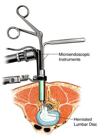 Minimally Invasive Spine Surgery » Lillian S. Wells Department of Neurosurgery at the University ...