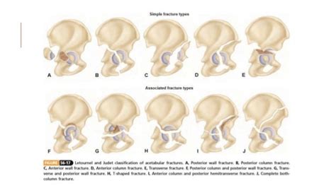 Classification Of Acetabular Fractures