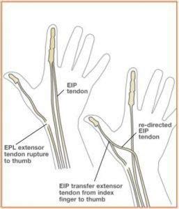 Tendon Transfer Hospital & Doctors in India - HBG Medical Assistance