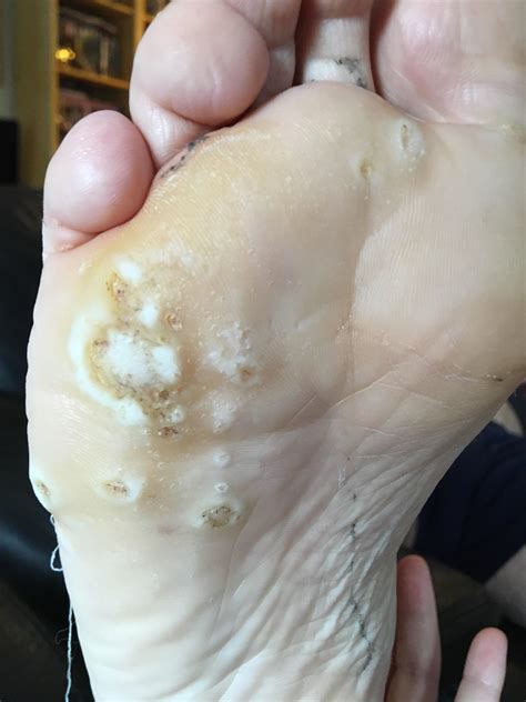 Just a healthy dose of plantar warts after 6 days of duct tape : r/popping