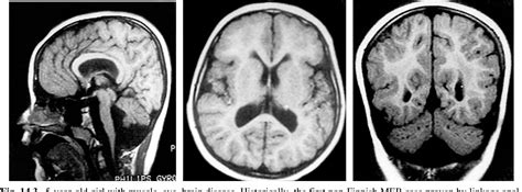 Lissencephaly Mri