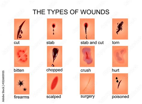 the types of wounds Stock Vector | Adobe Stock