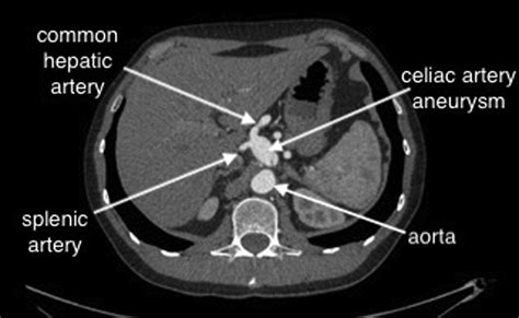 Surgical repair of a symptomatic celiac artery aneurysm with resection and end-to-end ...