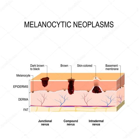 Melanocytic nevus — Stock Vector © edesignua #175414556