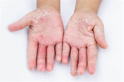 The Dry Hands, Peel, Contact Dermatitis, Fungal Infections, Skin Inf ...