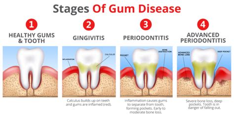 Periodontitis – Its Causes, Warning Signs, and How to Prevent It | Dr. Vlahos Family Dentistry