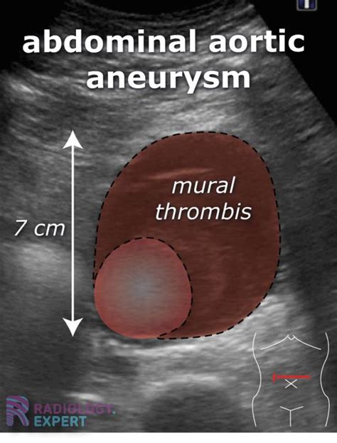 Abdominal ultrasound