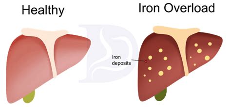 Hemochromatosis