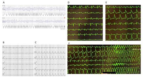 PO-01-076 DIAGNOSIS OF CORONARY VASOSPASM PROMPTED BY EPISODIC ST ...