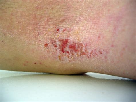 Eczema herpeticum: Symptoms, diagnosis, and treatment