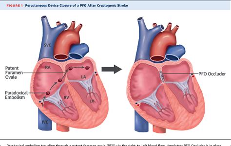 Device Closure of Patent Foramen Ovale in Patients With Cryptogenic Stroke: The Tide Has Turned ...