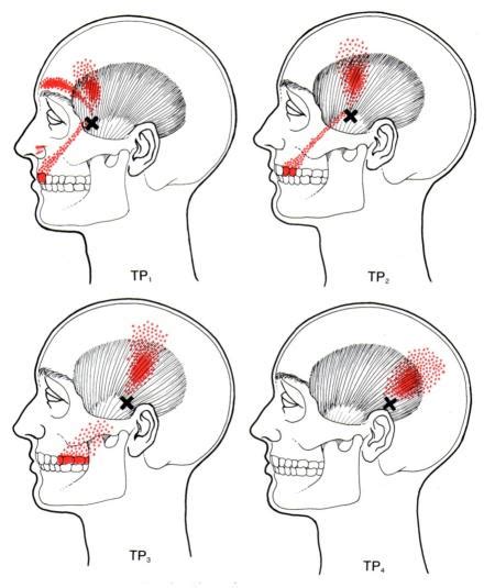 Temporalis | The Trigger Point & Referred Pain Guide