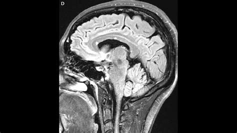 Corpus Callosum Lesions - The Neurology Hub