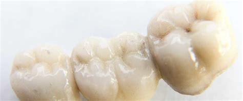 The Beauty and Benefits of Traditional Bridges for Dental Crowns