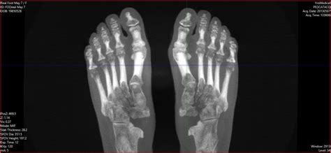 Weight-Bearing CT May Improve Diagnoses in Hallux Valgus Patients - CurveBeam