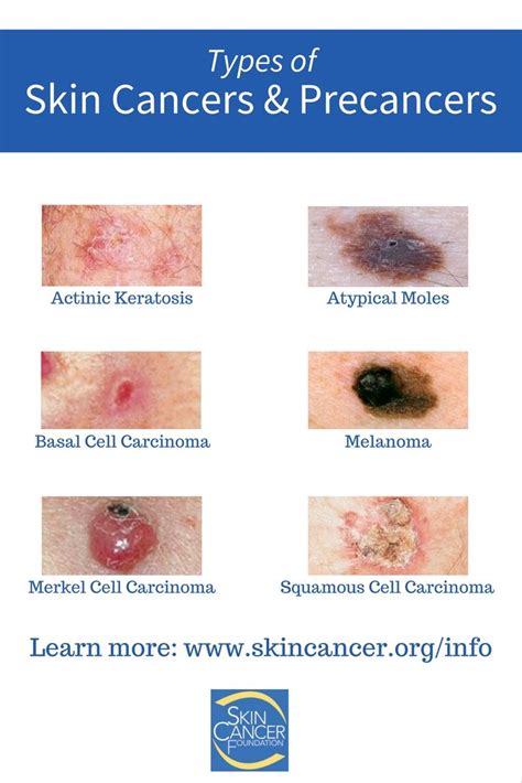 Pictures Of Different Types Of Skin Cancer – the meta pictures