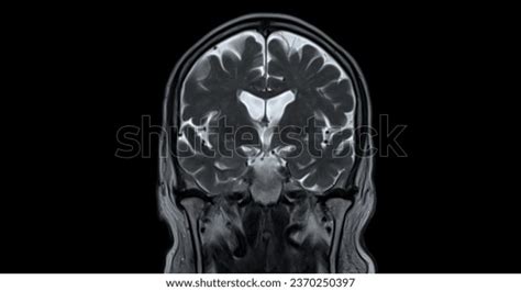 Mri Scan Brain Detect Brain Diseases Stock Photo 2370250397 | Shutterstock