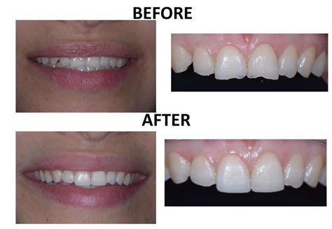 13+ Teeth Recontouring - MorganHauwa