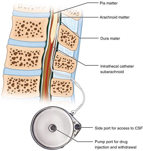 Intrathecal Drug Delivery System - spine specialist doctor in Surat - Dr.shishir mehta ...