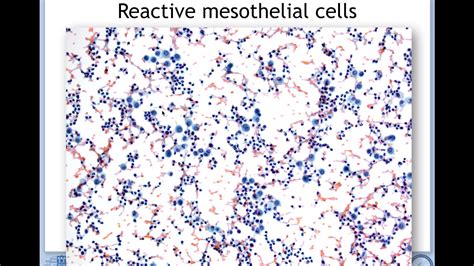 Prof. JFのレクチャー Pathology of mesothelial cells_ - YouTube