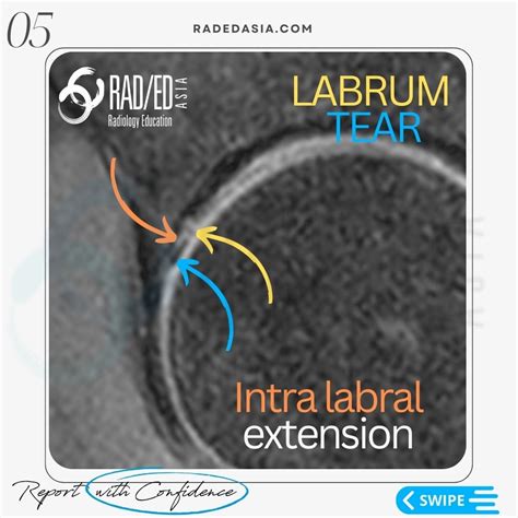 HIP LABRUM LABRAL TEAR MRI RADIOLOGY - Radedasia