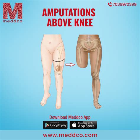 A Guide to Above the Knee Amputation