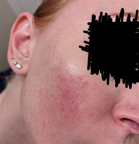 Help with Rosacea and/or Keratosis Pilaris on my face? : DermatologyQuestions