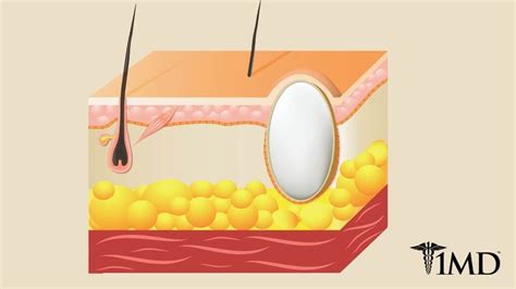 What's a Sebaceous Cyst? Signs, Treatments, and What to Expect | 1MD Nutrition™