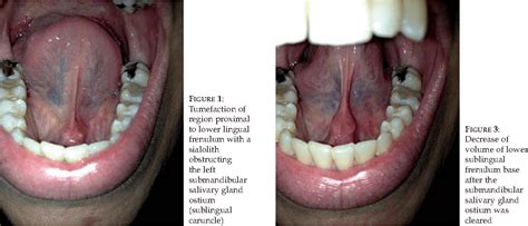 Sublingual Caruncle | News | Dentagama