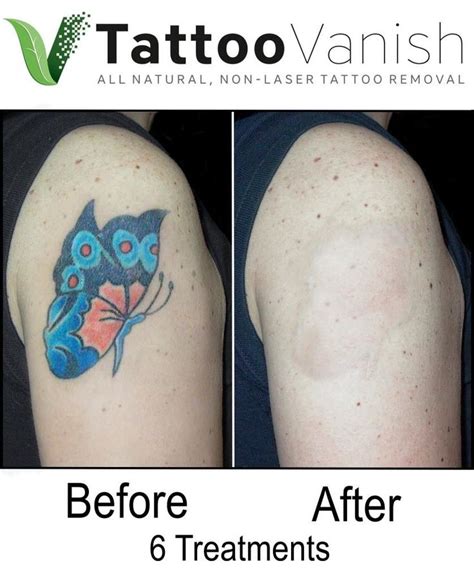 what does skin look like after tattoo removal - gertonfaruolo