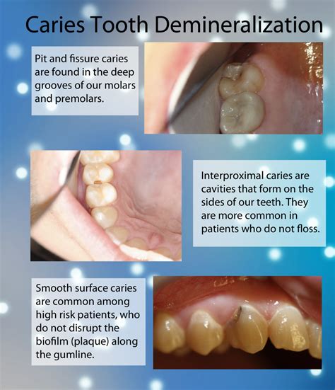 Caries & Tooth Demineralization – McFarlane Dental