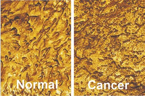 Cancer Cells Vs Normal Cells Microscope