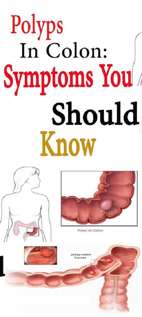 Colon Polyps: Symptoms You Should Never Ignore - FOR ALL WOMEN