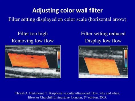 Image result for wall filter in ultrasound | Ultrasound, Vascular ultrasound, Diagnostic medical ...