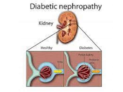 Diabetic nephropathy - Health Tips, Diabetic nephropathy Health Articles, Health News ...