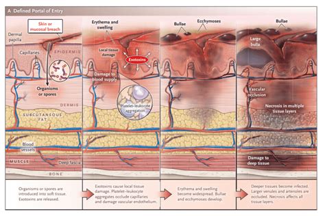 Necrotizing Soft Tissue Infection – Core EM