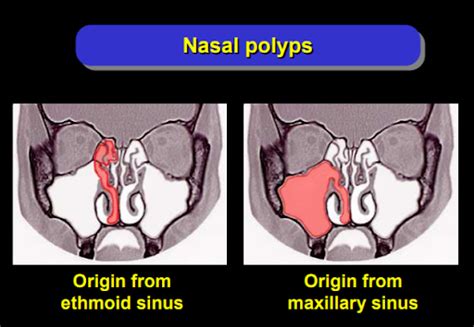 Nasal Polyps Treatment in Singapore | Dr Kevin Soh