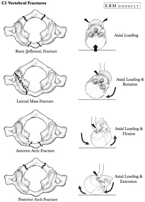 C1 Vertebral (Jefferson) Fractures - General Review | Medical technology, Radiology student ...