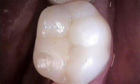 Porcelain Fillings | Smile Gallery | Garden City Implant & Dental