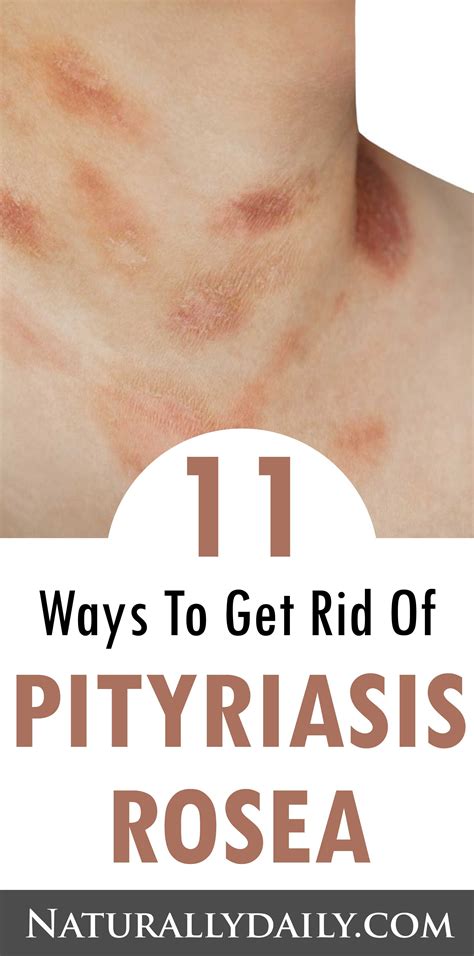 Pityriasis Rosea Treatment