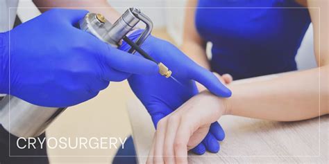 Cryosurgery — Georgia Dermatology & Skin Cancer Center