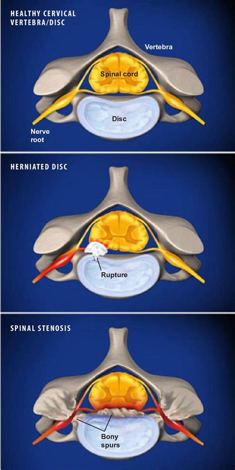 Radiculopathy Surgery Princeton, NJ | Pinched Nerve Treatment