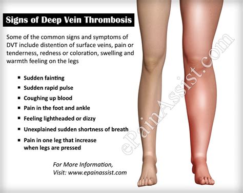 Warning Signs of Deep Vein Thrombosis: How do I know if I have DVT? | Deep vein thrombosis, Vein ...