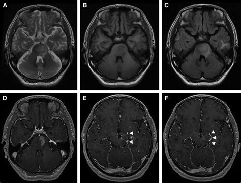 MRI revealed a left pontine mass exhibiting a high signal intensity on... | Download Scientific ...