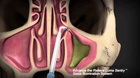 Balloon Sinuplasty vs.Traditional Sinus Surgery with ENT Dr. Timothy Ragsdale - YouTube